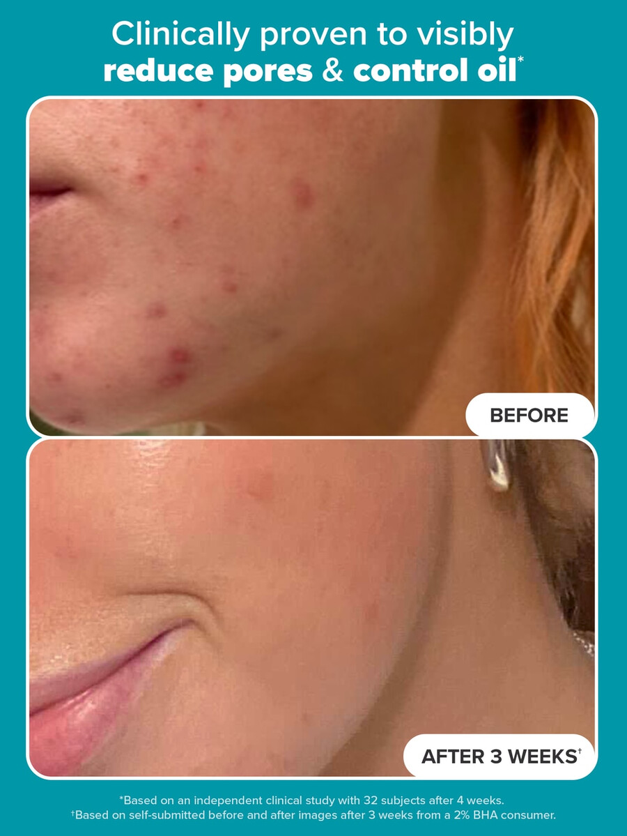 2 bha exfoliërende toner pads