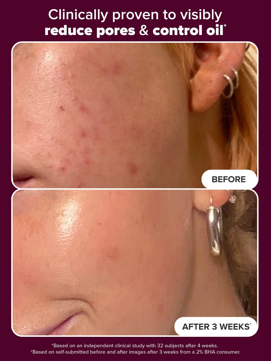 feestdageneditie 2 bha exfoliërende toner